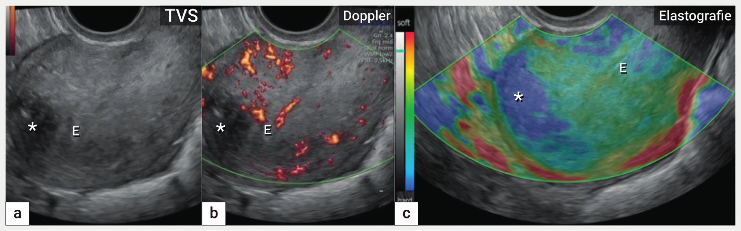 Elastografie<br>
Ultrazvukové zobrazení dělohy (B-mode, škála šedi) s koncentricky zesílenou přední a zvláště zadní stěnou na podkladě adenomyózy
(a), zobrazení barevným dopplerem s nezměněnou perfuzí v přední a zadní stěně děložní (b), elastografie s označením fibrotických změn
hvězdičkou (modrá oblast) uložených převážně ventrálně ve fundu (c).
E – endometrium