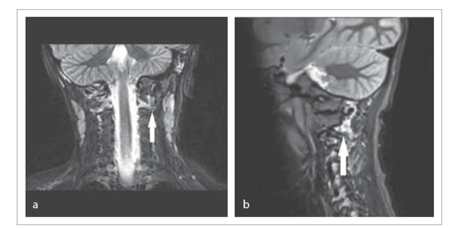 MR krku a páteře, STIR frekvence – prosáknutí měkkých tkání v okolí
atlantoaxiální subluxace (viz šipku).<br>
a) koronární projekce, b) sagitální projekce.<br>
Fig. 1. MRI of the neck and spine, STIR frequency – soft tissue infiltration around
the atlantoaxial subluxation (see arrow).<br>
a) coronary projection, b) sagittal projection.