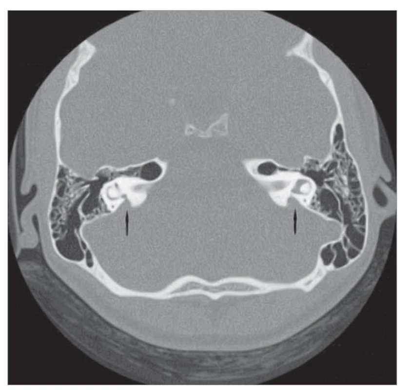 EVA oboustranně (označeno šipkou), CT snímek, axiální projekce.<br>
Fig. 5. EVA on both sides (marked with an arrow), CT image, axial projection.