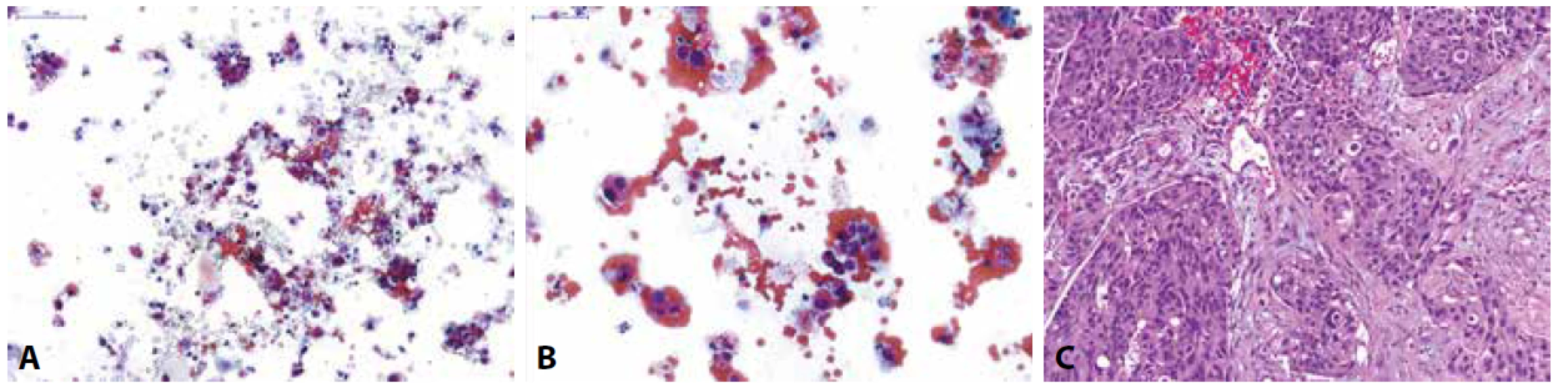 Pacient s makroskopickou hematurií při prvozáchytu tumoru močového měchýře na CT.<br>
(A,B) Spontánně vymočená moč; na krevnatém pozadí zastiženy normální urotelie z různých vrstev sliznice a atypické suspektní urotelie s posunutým nukleocytoplazmovým
poměrem ve prospěch jádra, hyperchomázií, nepravidelnostmi jaderné membrány a granulárním chromatinem; dle Pařížské klasifikace kategorie:
HGUC<br>
(C) Definitivní histologický materiál u pacienta získaný TURT s odstupem měsíce po pozitivní močové cytologii; zastižen je invazivně rostoucí špatně diferencovaný
uroteliální karcinom, dle WHO 1973 grade 3, dle WHO 2016 high-grade infiltrující uroteliální karcinom.