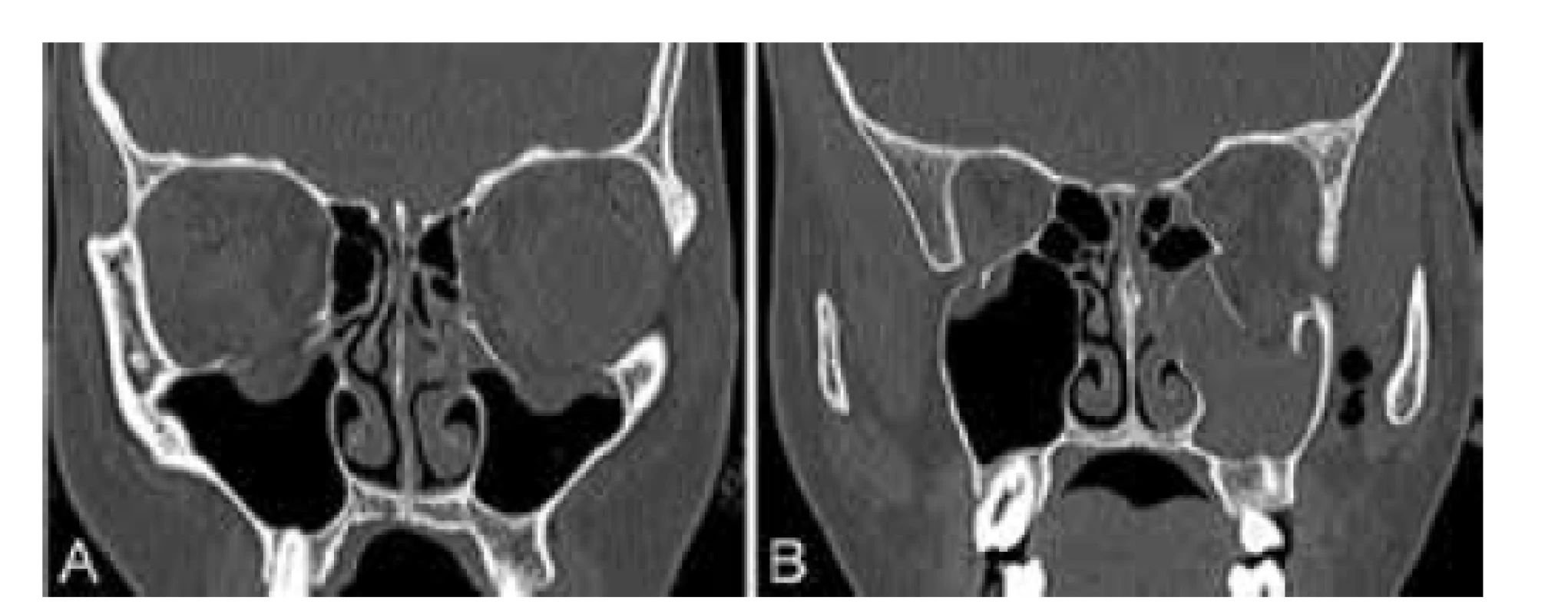 CT vyšetření v den úrazu (A) Oboustranná zlomenina
spodiny očnice, (B) Přítomnost vzduchu v levostranné fossa pterygopalatina
(napravo)