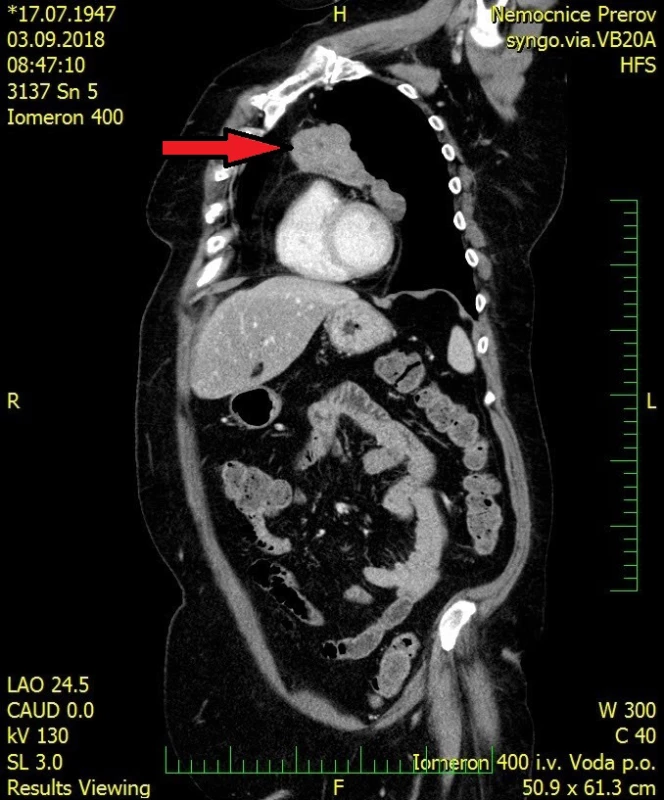  CT vyšetření hrudníku a břicha s kontrastní látkou, sagitální řez, tumor
předního mediastina – šipka