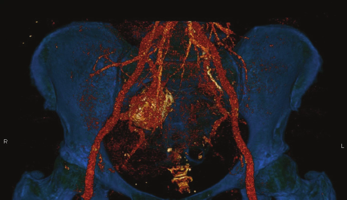 CT AG − Aneuryzma na vnitřní pánevní tepně vpravo<br>
Fig. 1: CT AG – Right hypogastric artery aneurysm