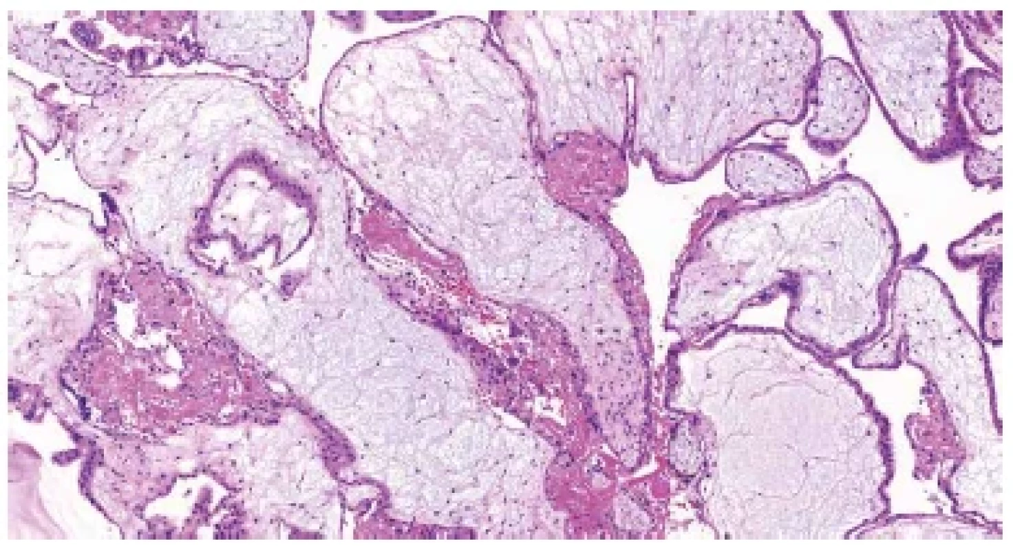 Hydropický potrat. Edématózní choriové klky s trofoblastickými inkluzemi
(HE, 100x).