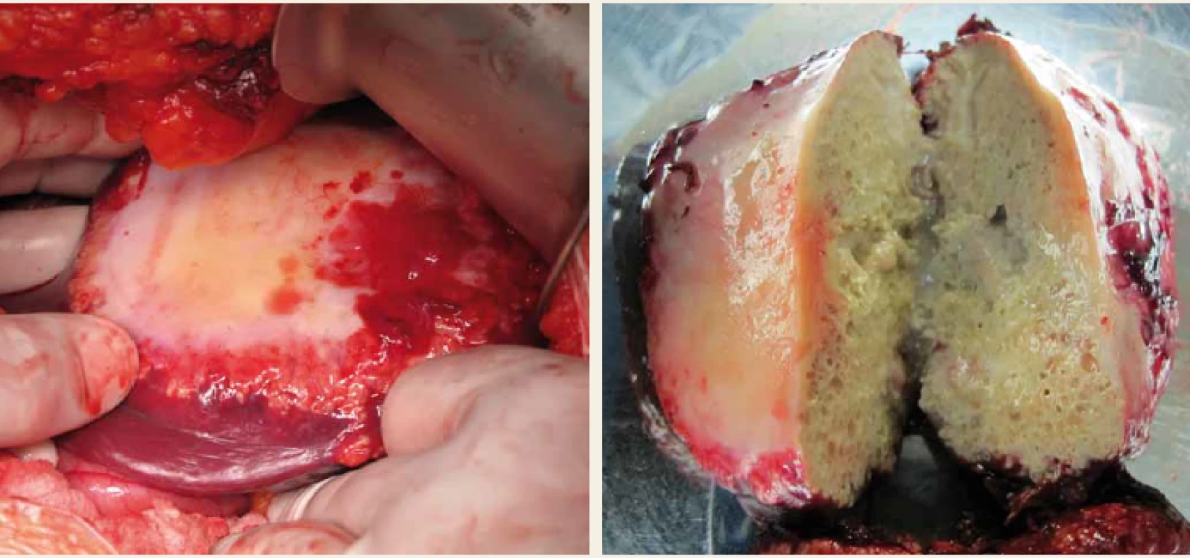 Parazitární cysta v levém laloku jater; peroperační nález a resekovaná cysta.<br>
Fig. 3. Parasitic cyst of the left liver lobe; intraoperative finding and resected cyst