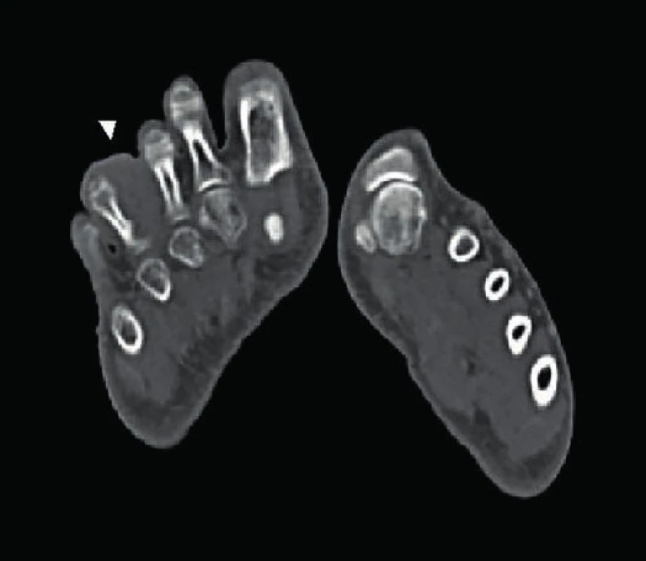 V měkkých tkáních pravé nohy dorsálně mezi III. a IV. prstem je přítomen
útvar o vel. 37 x 35 x 32 mm nasedajíci na bazi základního článku IV.
prstu, který má nativně denzitu 70 HU a sytí se jen velmi málo kontrastní
látkou (prof. Ferda, Klinika zobrazovacích metod, FN Plzeň).
