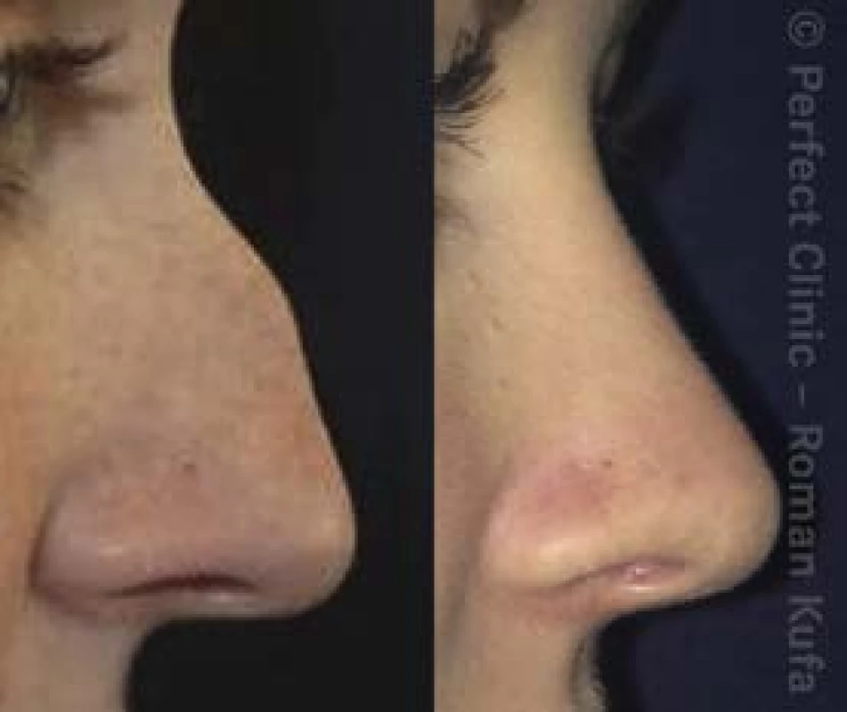 Nos před operací a po ní