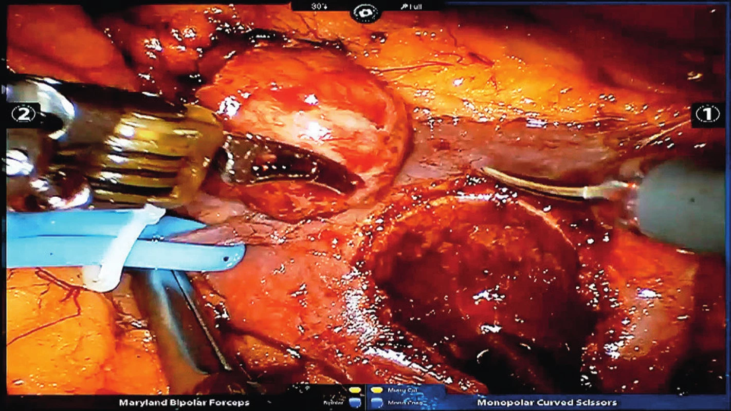 Vyjmutí nádoru levé ledviny se zaklipováním
segmentární arterie