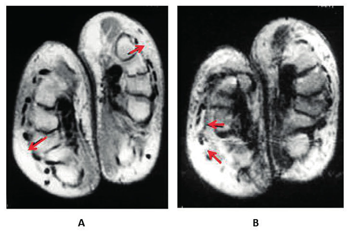 Fenomén boxerské rukavice u syndromu RS3PE. MRI ruky (upraveno podle (19)): A – edém podkoží (šipky) při axiální projekci
protonové denzity, B – tekutina synoviální pochvy šlach extenzorů (šipky) v axiální projekci T2