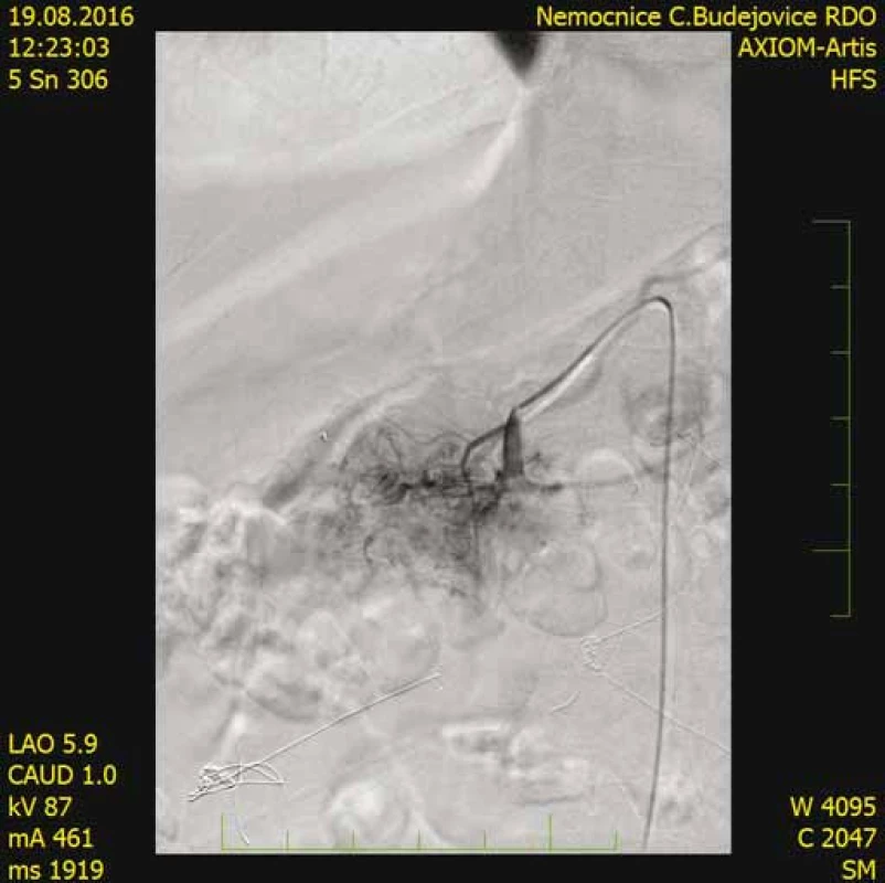 CT angiografia s nálezom patologickej vaskularizácie
v oblasti hlavy pankreasu.<br>
Fig. 9. CT angiography shows pathological vascularisation
in the region of the pancreas head.