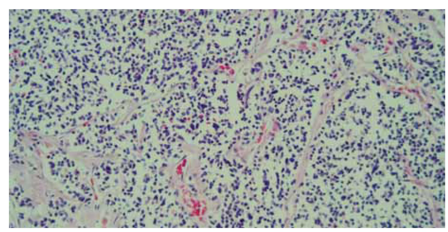Histológia – parenchým pečene infi ltrovaný malobunkovou nádorovou
proliferáciou, farbenie hematoxylin-eozinom, zväčšenie 40×.<br>
Fig. 7. Histology – liver parenchyma infi ltrated by small cell tumour proliferation,
hematoxylin eosin staining, magnifi cation 40×.