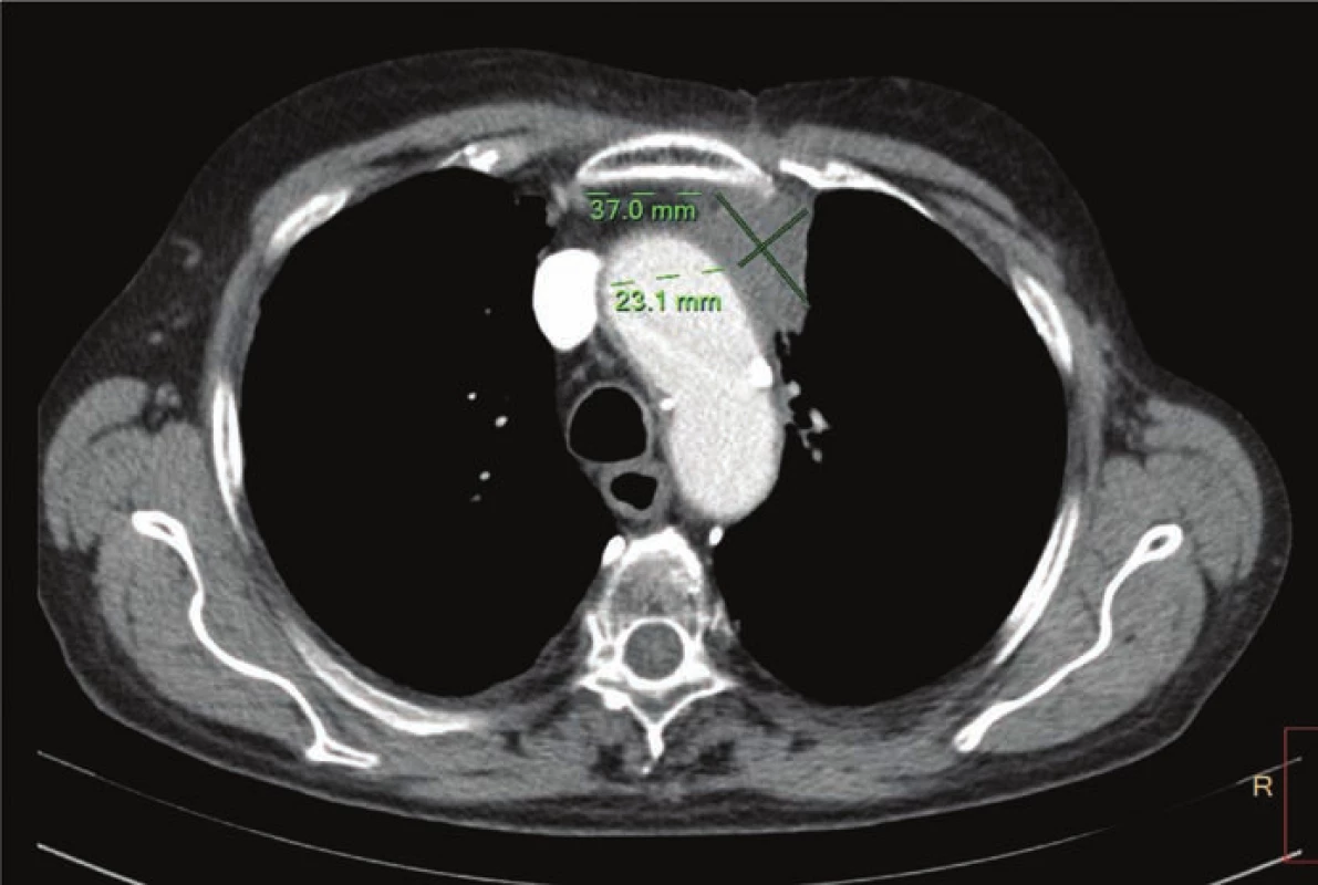 CT hrudníku a břicha z 10. 2. 2016 po čtyřech aplikacích nivolumabu – regrese
patologického ložiska v hrudníku.
