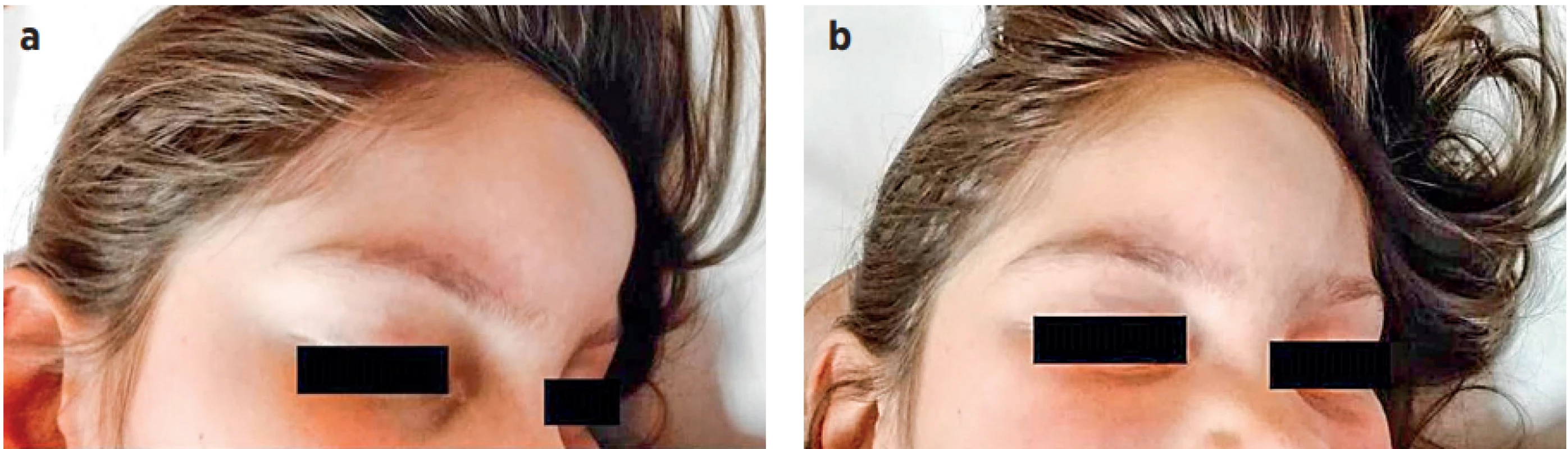 a, b (P1). Fluktuující rezistence v oblasti čela při subperiostálním abscesu frontální kosti. (Se souhlasem z archivu MUDr.
Jany Hrubé)<br>
Fig. 1a, b (P1). Fluctuant resistance in the forehead due to the subperiosteal abscess of the frontal bone. (Dr. Jana Hrubá’s 
archive, with her approval)