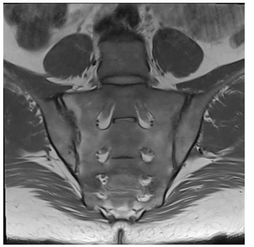 MR vyšetření s nálezem aktivní sakroilitdy, edematózní prosáknutí
struktury sakra i přilehlých pánevních kostí vlevo