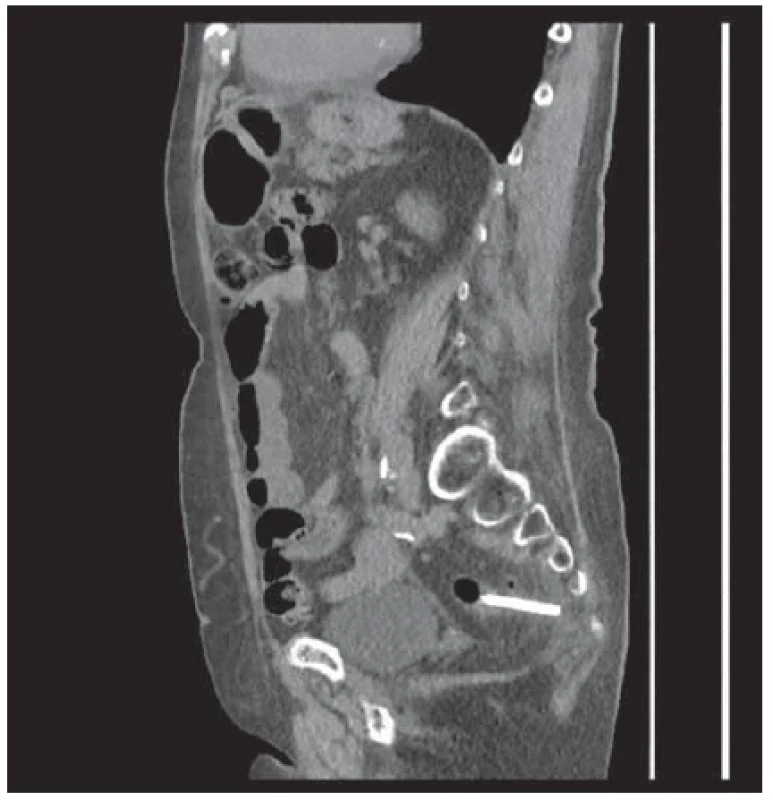 Sagitální rovina CT břicha/pánve, hyperechogenní cizí
těleso – stent v sigmatu. <br> 
Fig. 2. Sagittal plane CT of the abdomen/pelvis, hyperechoic foreign
body – stent in the sigmoideum.