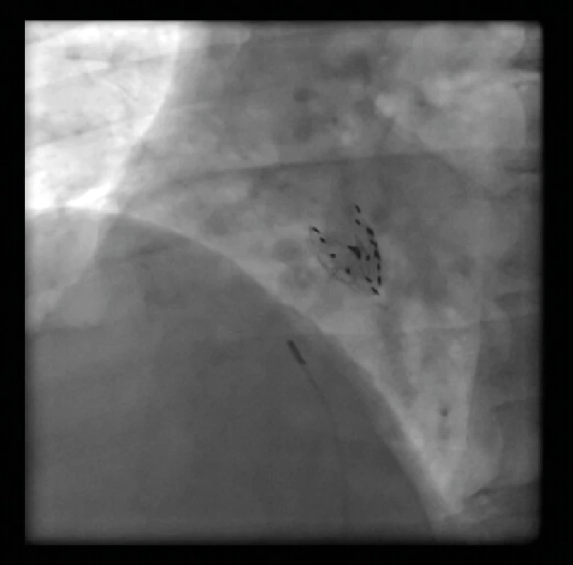 Cardia PFO okludér (Ultrasept) – RTG zobrazení 