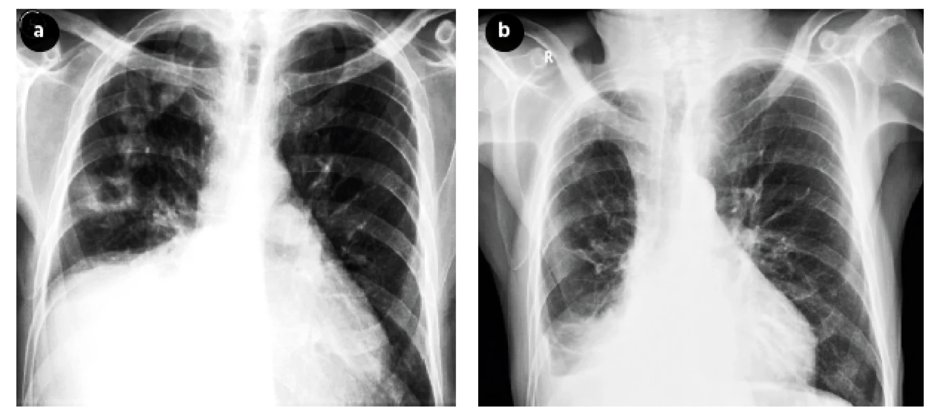 Chest X-ray before (Figure 3a) and after (Figure 3b) treatment