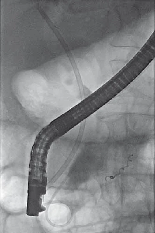 ERCP – traspapilárně zavedený
stent do d. choledochus a mono
pigtail do dutiny pseudocysty.
Fig. 5. ERCP – transpapillary stent
placement into common bile duct
and mono pigtail stent placement into
the pseudocyst cavity.