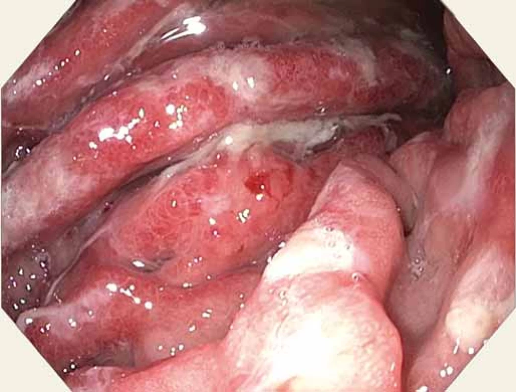 Sliznice žaludku – velká křivina – tuhé navalité
řasy, přechodné spontánní krvácení.<br>
Fig. 3. Gastric mucosa – greater curvature – rigid mucosa,
transient spontaneous bleeding.