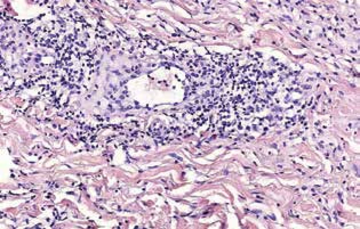 Histologický obraz ACA – biopsie z dorza pravé ruky
Hluboký perivaskulární a  intersticiální infiltrát lymfocytů
s plazmocyty a sklerotizace kolagenního vaziva.