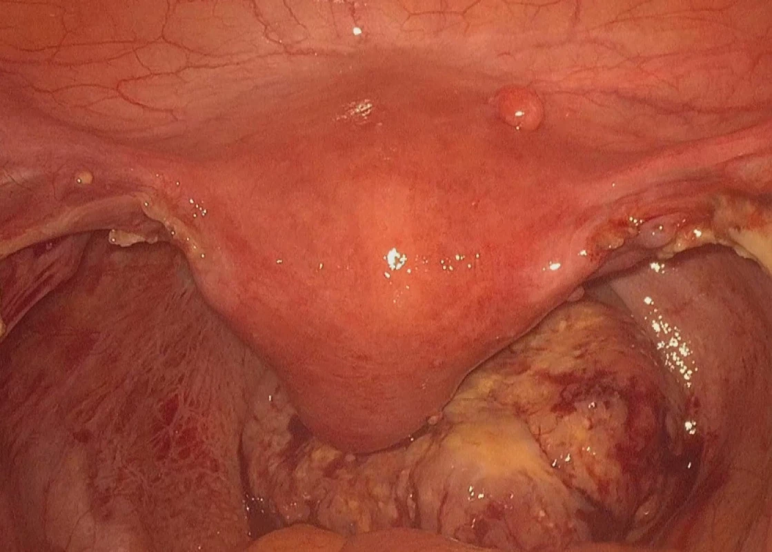 Tumor rekta a peritonea