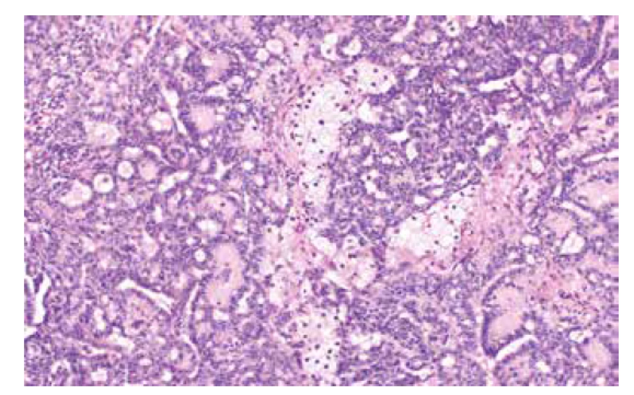 Středně diferencovaný nádor ovaria ze Sertoliho-Leydigových buněk
(barvení HE, 200x).
