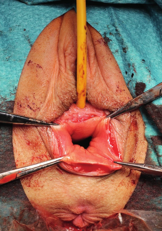 Peroperační snímek fixace vaginální stěny peany