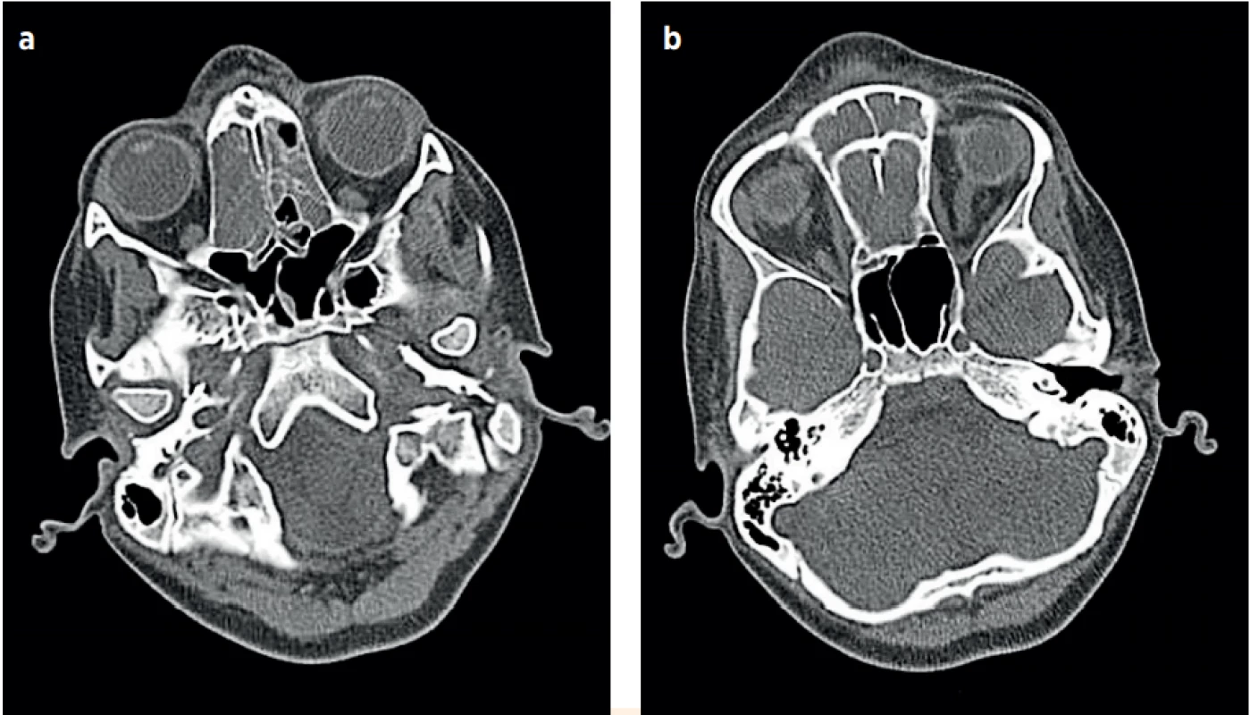 a, b (P1). Vstupní CT (1. hospitalizační den), obliterované ethmoidální dutiny, frontální dutiny a edém podkoží kořene nosu.
(Za laskavého přispění MUDr. Pavla Rejtara)<br>
Fig. 2a, b (P1). The CT imaging (the first day of the hospitalisation), obliteration of the ethmoid and frontal cavities, and hypodermal oedema of the nose root. (Credit Dr.Pavel Rejtar)
