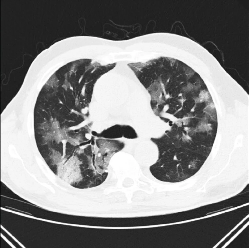 Pacient s prokázanou virovou pneumonií covid-19 a typickým nálezem multifokálních okrsků denzit mléčného skla a vpravo v S6 o obrazem 
„crazy paving“ a rozšířenými bronchy v S6