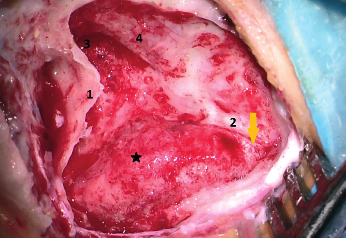 Peroperační nález: antromastoidektomie vlevo, patrná
zadní stěna zvukovodu (1), sinodurální (Citelliho) úhel (2), aditus
ad antrum mastoideum (3), skeletizace střední jámy lební (4),
skeletizace esovitého splavu – periflebitida s granulacemi na stěně splavu (hvězdička), kraniálně klidná, bělavě prosvítající stěna
splavu (šipka)