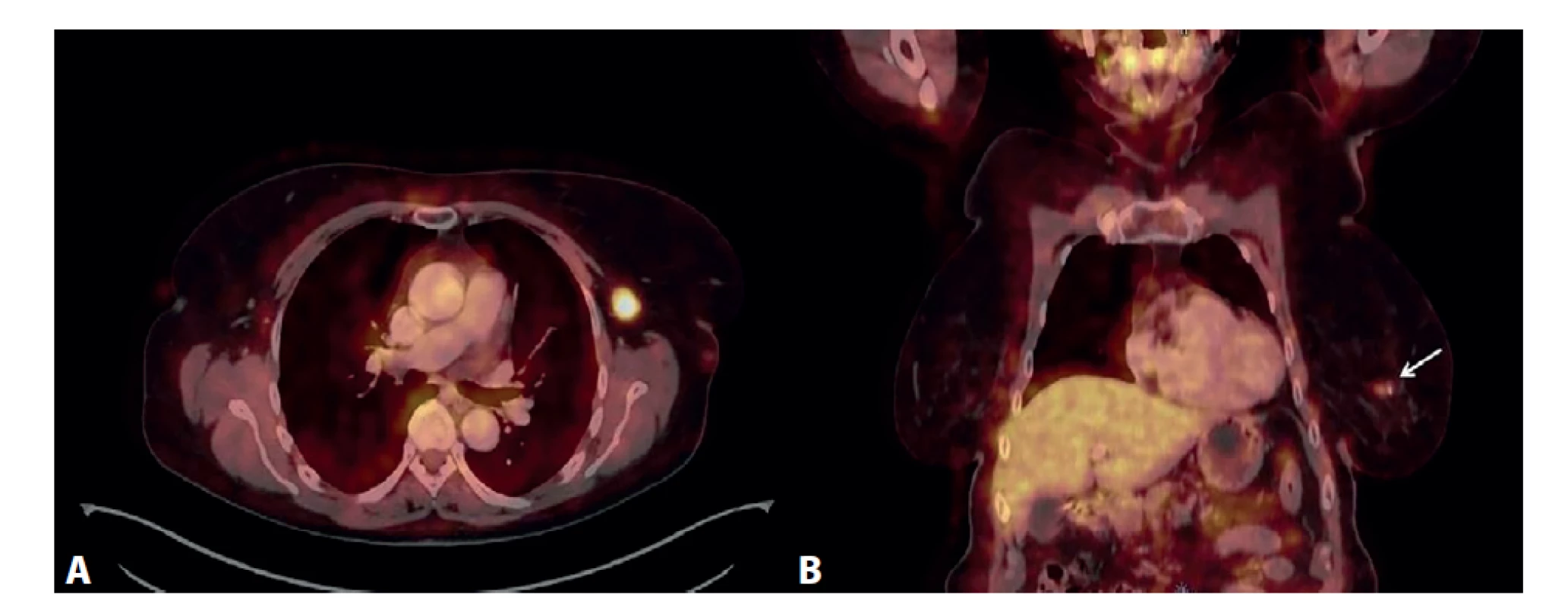 PET/CT vyšetření<br>
A) Výrazný hypermetabolizmus glukózy v jedné lymfatické uzlině levé axily, axiální zobrazení. B) Mírná akumulace FDG
v ložisku levého prsu (označeno šipkou), koronální zobrazení.<br>
Fig. 7: PET/CT examination<br>
A) Significant glucose hypermetabolism in one lymph node of the left axilla, axial view. B) Mild accumulation of FDG in
the lesion of the left breast (marked by the arrow), coronal view.