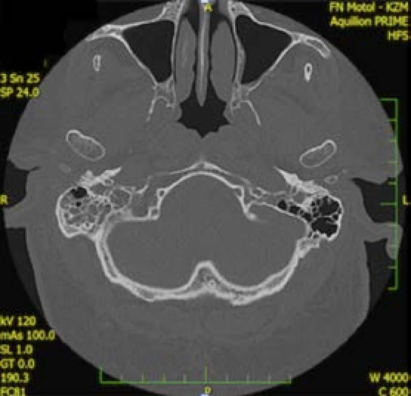 CT nález otitis <i>externa maligna</i>