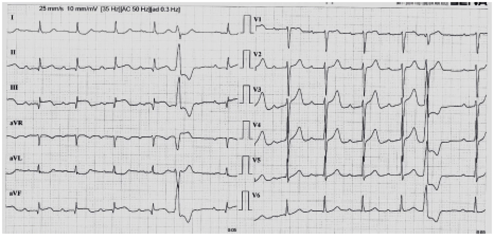EKG křivka 3: kontrolní EKG po dokončení
trombolýzy s úpravou změn ST úseků
