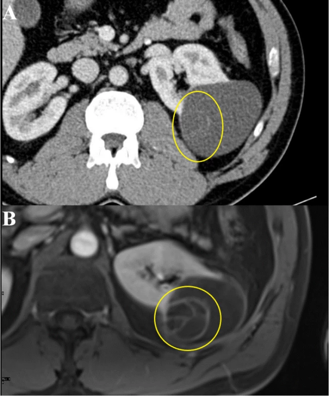 Srovnání téže cystické léze na CT a MR vyšetření
(A – CT, B – MR)<br>
Fig. 2. Comparison of the same cystic lesion on CT and
MRI (A – CT, B – MR)
