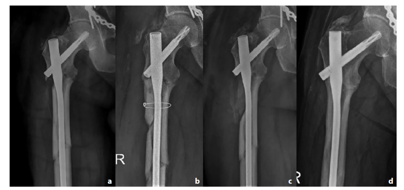 Pacient č. 3; a – úrazový snímek; b – kostní semicirkulární defekt s PMMA spacerem; c – defekt po spongioplastice;
d – plně prostavěný defekt po 2 letech<br>
Fig. 4: Patient 3; a – initial X-ray; b – PMMA spacer inside the semicircular bone defect; c – defect after bone grafting; d –
bone union after 2 years