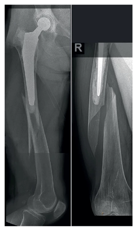 Periprotetická fraktura diafýzy pravého femuru –
úrazový snímek<br>
Fig. 1: Periprosthetic fracture of the right femoral diaphysis
– initial X-ray