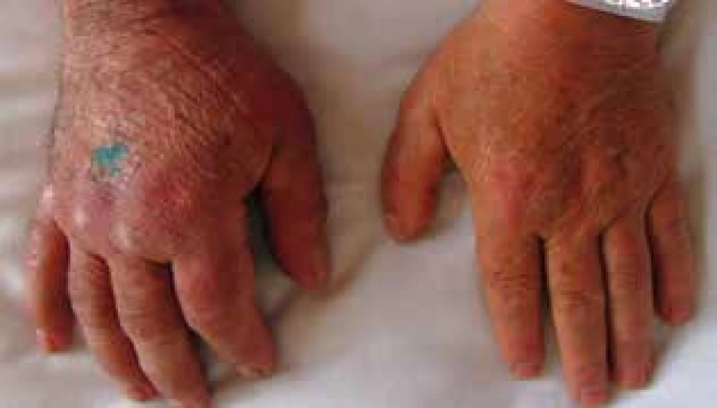 Stranová diference horních končetin – otok
a lividně-erytémové změny PHK, hojící se rána po probatorní
excizi na dorzu ruky