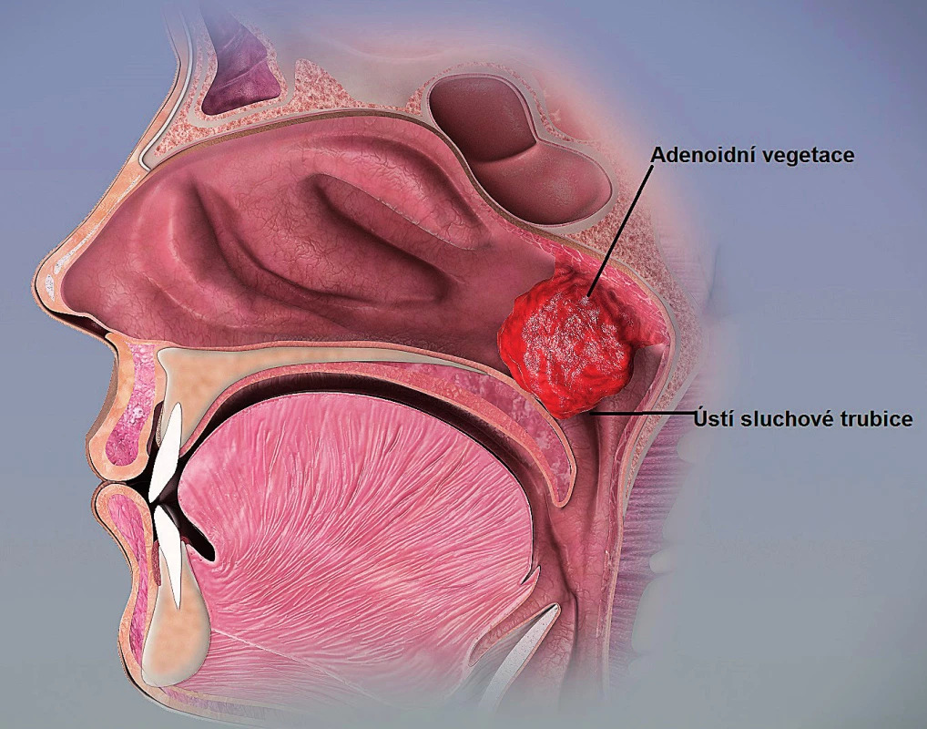 Vztah adenoidní vegetace a ústí sluchové trubice
(upraveno dle https://en.wikipedia.org/wiki/Adenoid_
hypertrophy).