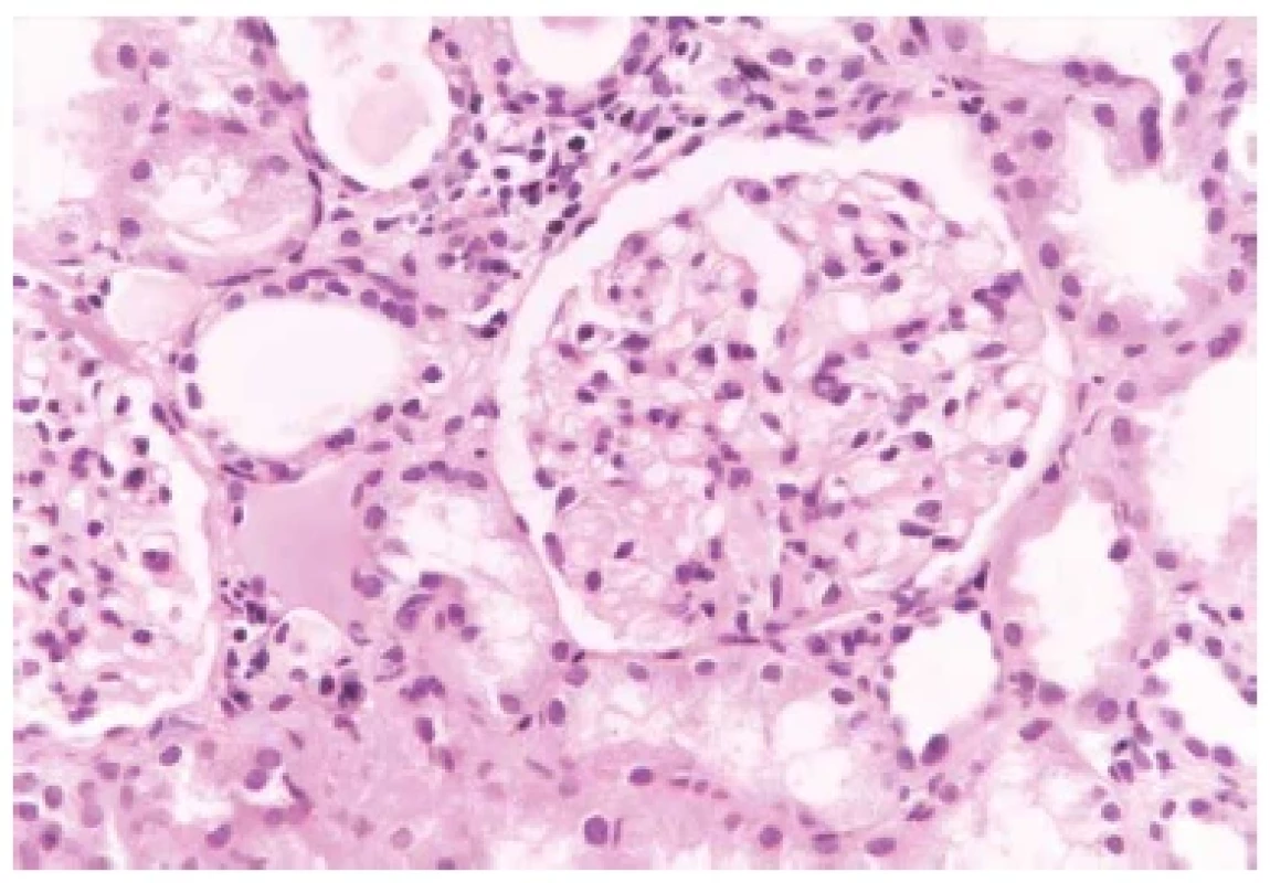 Glomerulus s normální buněčností, bez proliferace. Přilehlé okolí
s rozšířeným intersticiem s mírným zánětem a kanálky s oploštělou výstelkou.
Barveno hematoxylinem eosinem (zvětšení 200x).