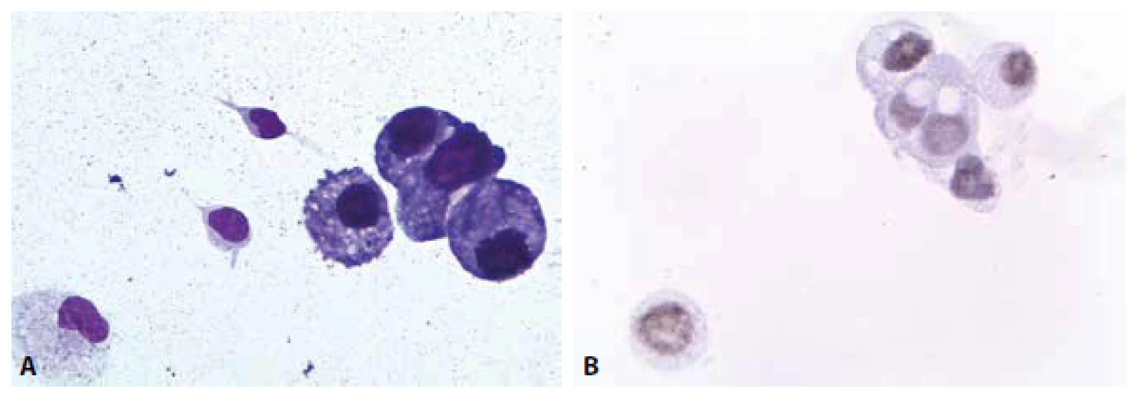 Muž, 73 let anamnéza plicního karcinomu. Zhoršení stavu, febrilie, k vyloučení zánětu. (A) Mírná suspektně nádorová pleocytóza
v barvení MGG. Atypické buňky jednotlivě i v kohezivních skupinkách. 600x. (B) Jaderná pozitivita TTF1 v nádorových buňkách. 600x.