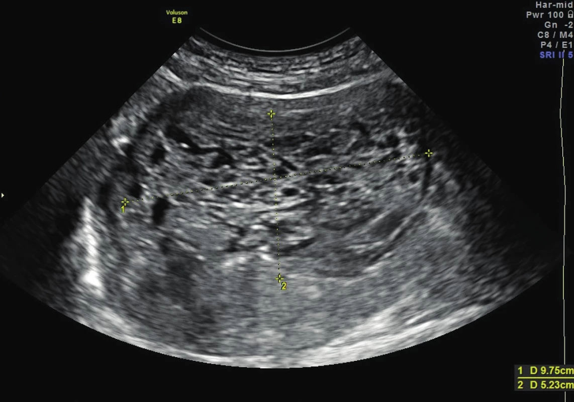 Suspektní tumor dělohy – abdominální pohled