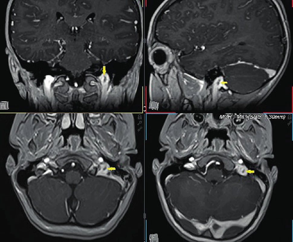 MRI, T1 vážená sekvence, předoperačně, obtékaný defekt v bulbu v. jugularis interna vlevo
