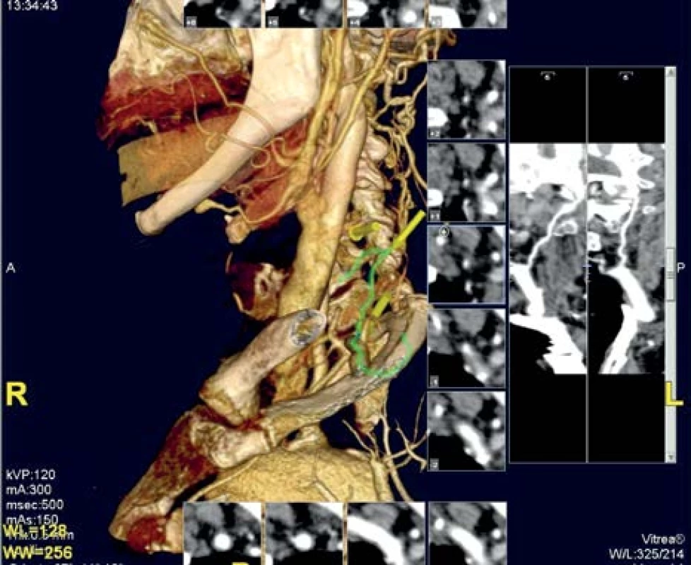 CT angiografie: okluze levé AV, plnění kolaterál do segmentu V2