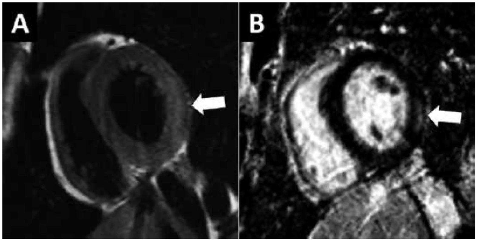 MR vyšetření myokarditidy. 17 letý pacient s klinickým podezřením
na akutní myokarditidu (EKG změny, systolická dysfunkce LK, vysoce pozitivní
troponin I, normální koronarogram). A) V T2-váženém obrazu je patrný
edém laterální stěny levé komory (šipka). B) Zobrazení pozdního nasycení
gadoliniem. Pruhovité ložisko pozdního nasycení v zevní vrstvě myokardu
(subepikardiálně) odpovídající nekróze.