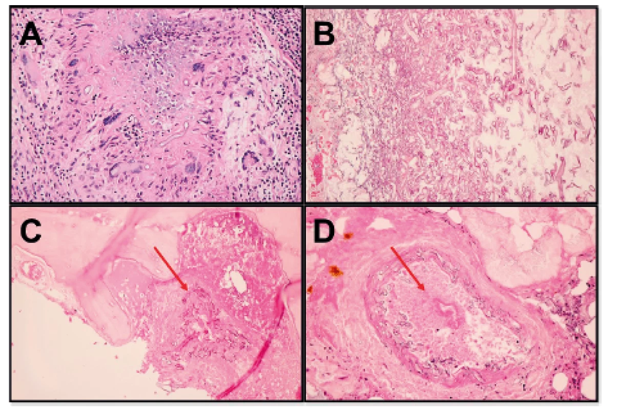 A-Měkké tkáně: epiteloidní granulomy s obrovskými
mnohojadernými buňkami, v centru granulomů nekróza, hnisavý
zánět a pomnožená vlákna mykózy (HE, 400x); B: Maxilární sinus:
pomnožená vláknitá mykofyta v nekróze na povrchu (HE, 400x);
C: nosní septum: infitrace kosti mykózou (viz šipka) (HE, 200x); D:
Invaze mykózy do cévy s počínající trombózou (viz šipka) a s nekrózou
stěny (HE, 400x).