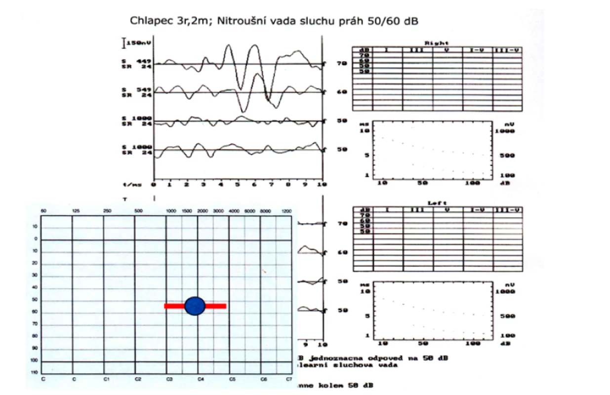 Vyšetření BERA není frekvenční. Práh sluchu je v oblasti max. akustického tlaku (kol. 2 kHz) na hladině intenzity
50/60 dB. Není jasné, jaký je práh pod a nad touto oblastí