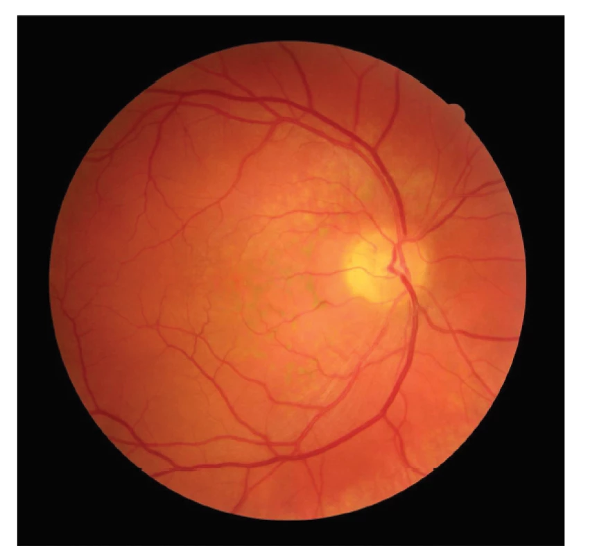 Snímek očního pozadí pravého oka pacienta s hemangiomem
cévnatky