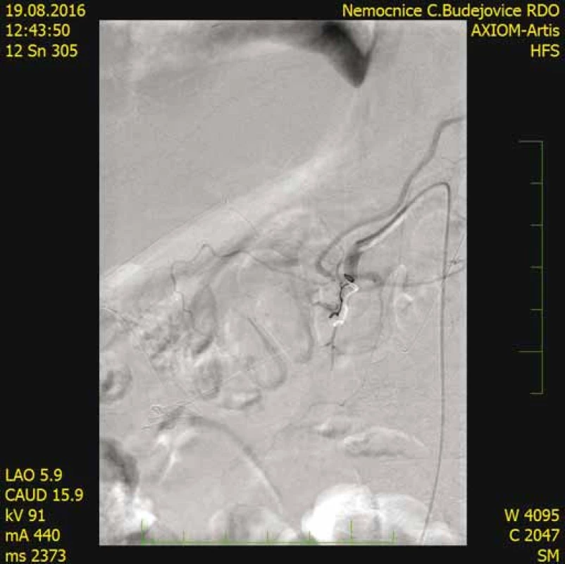 CT angiografi a (po embolizácii arteria gastroduodenalis)
bez nálezu patologickej vaskularizácie v oblasti
hlavy pankreasu.<br>
Fig. 10. CT angiography (after embolisation of arteria
gastroduodenalis) shows no pathological vascularisation
in the region of the pancreas head.
