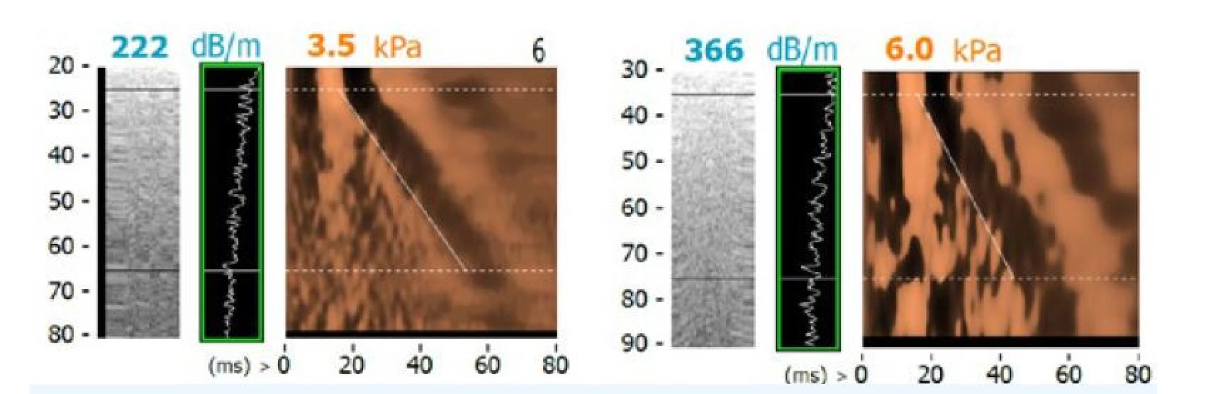 Měření CAP přístrojem FibroScan – normální játra (A) a těžká steatóza grade 3 (B)