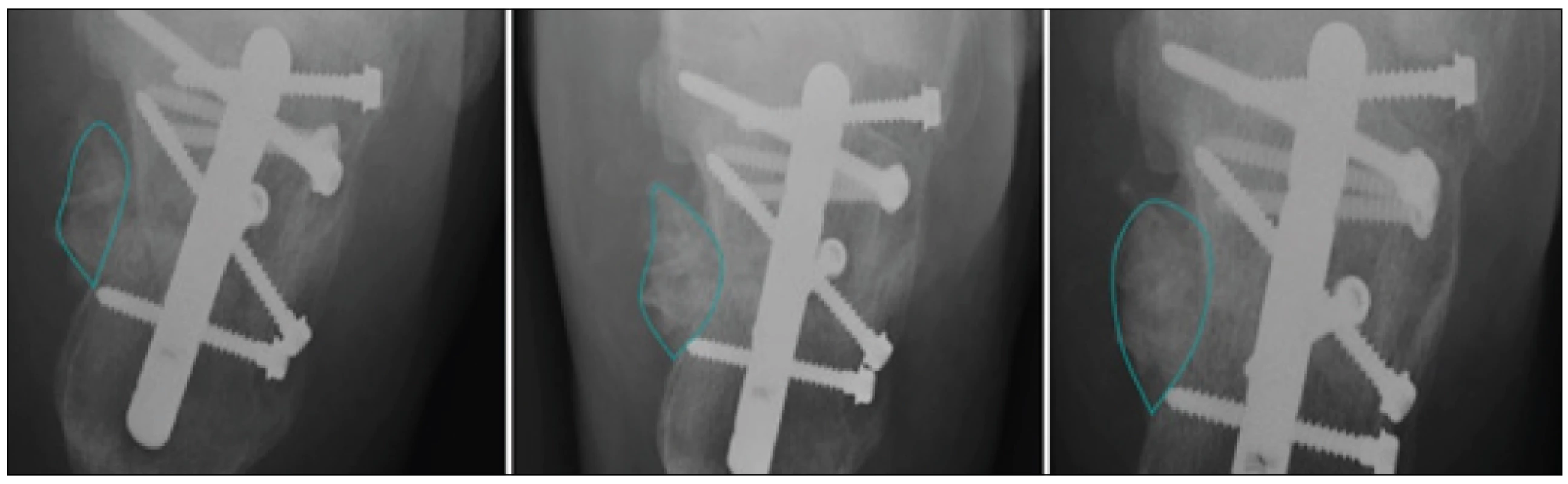 Application of the active contour method (green curve) that detect the periosteal callus area in clinical X-ray image data